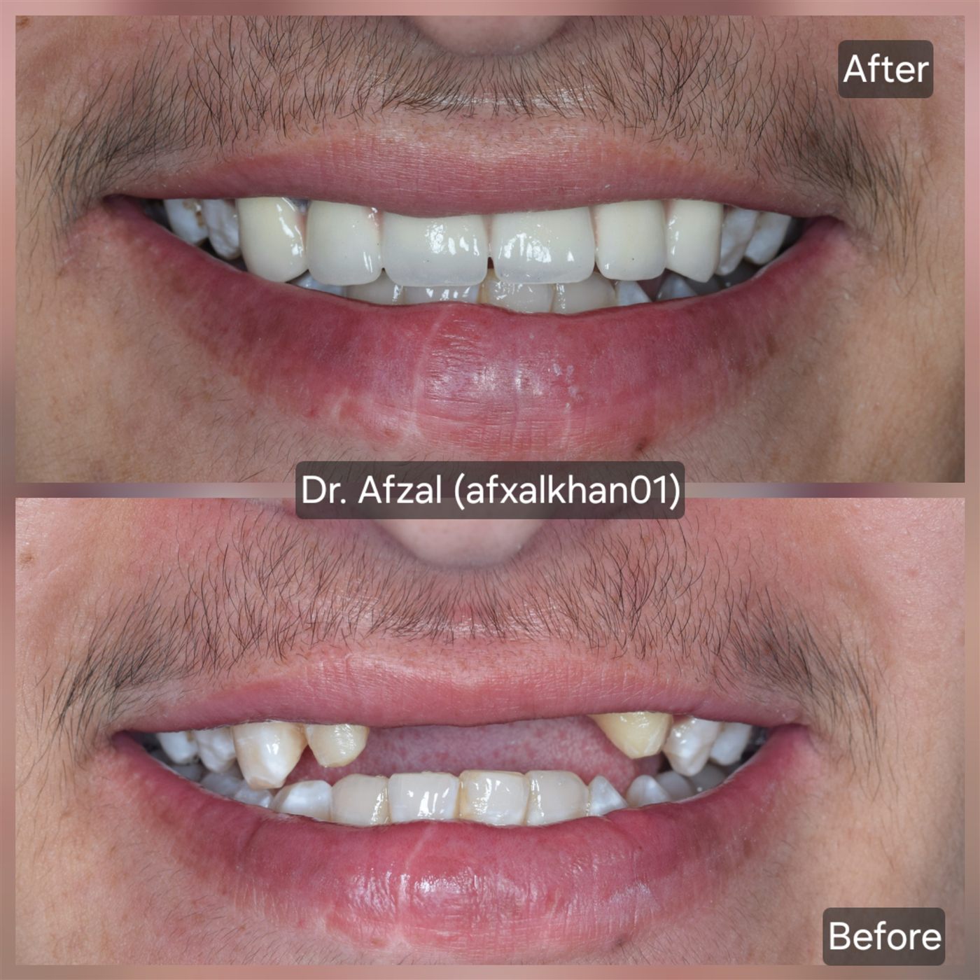 Smile Makeover: Case 1, before and after
