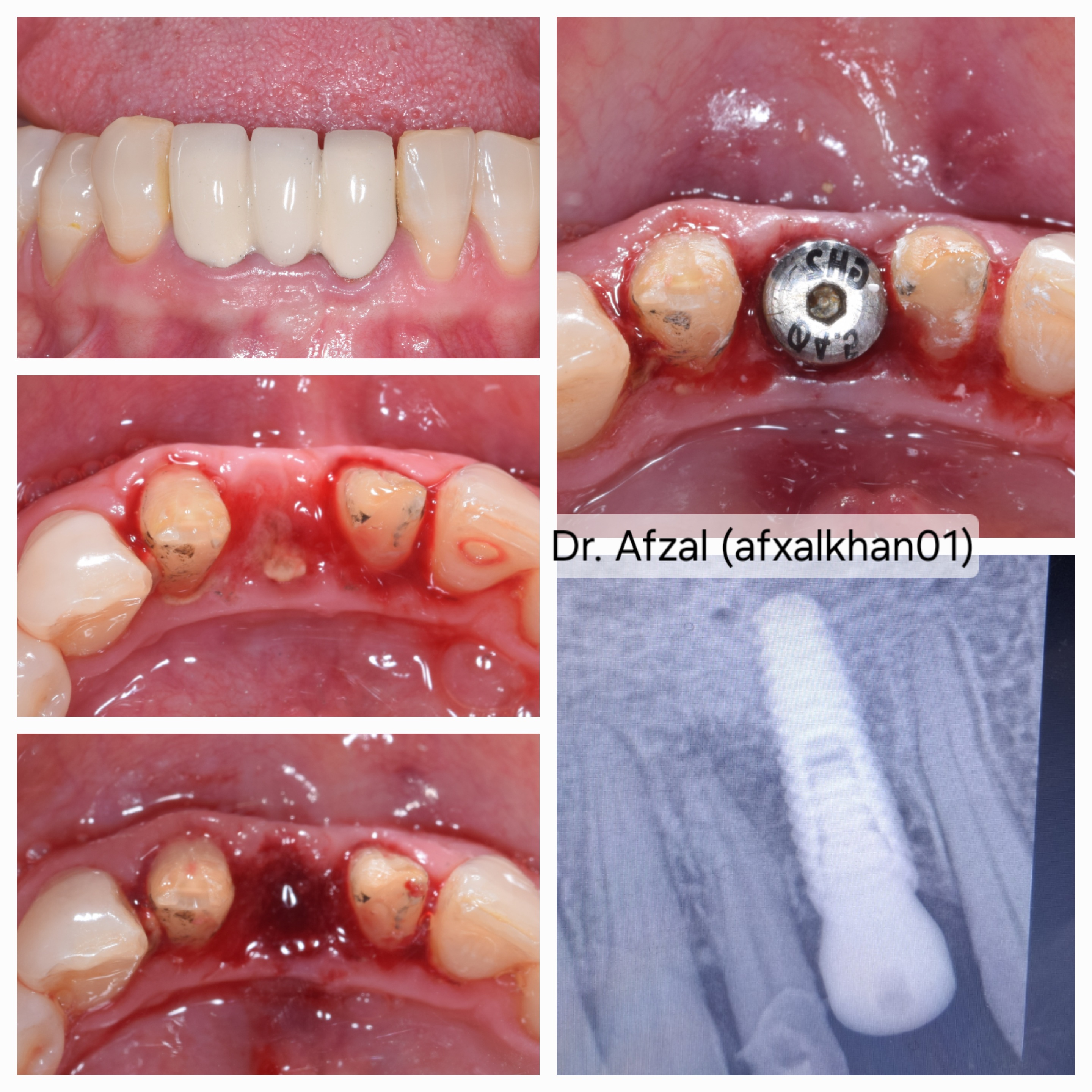 Dental Implant: Case 2, surgical photos and X-ray