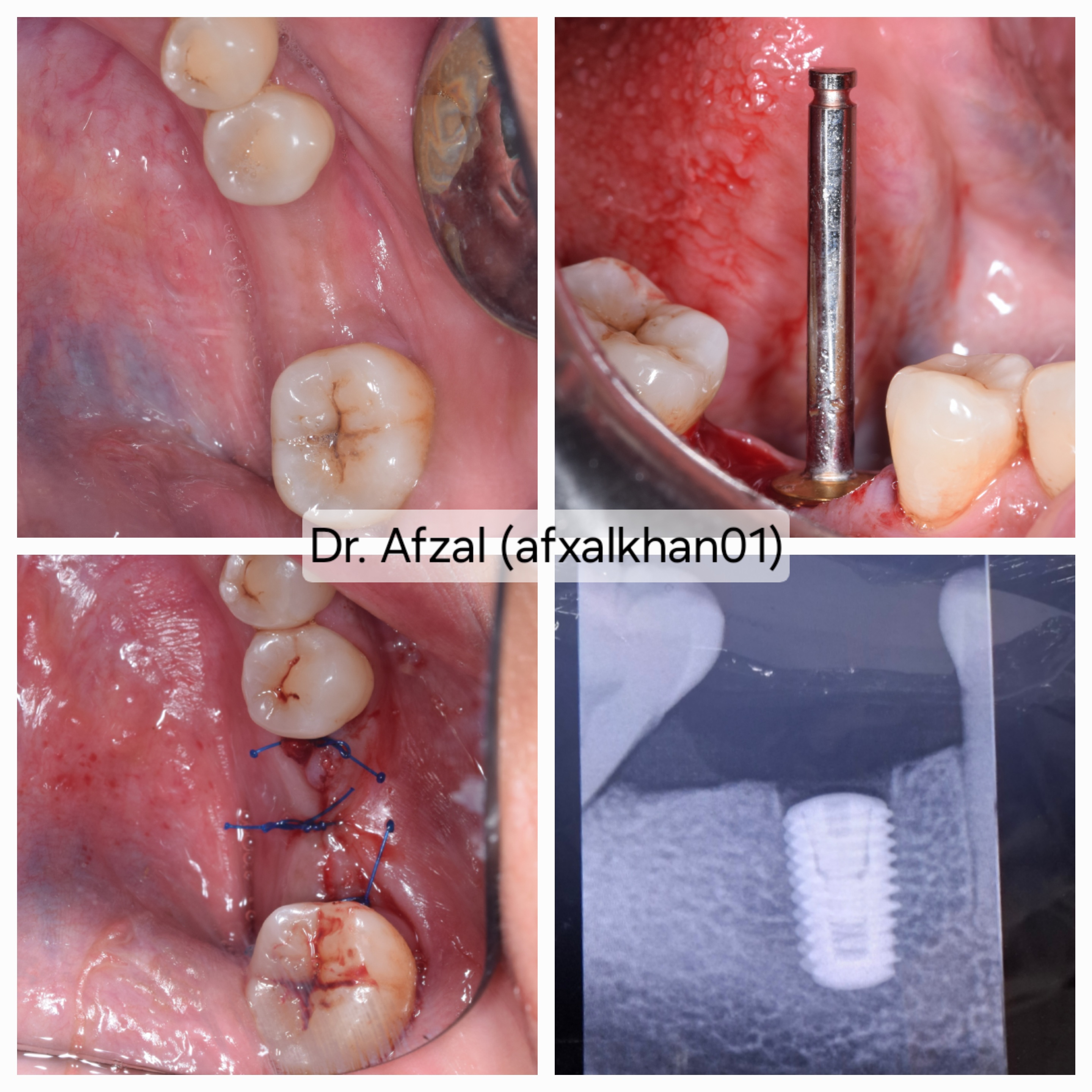 Dental Implant: Case 3, surgical photos and X-ray