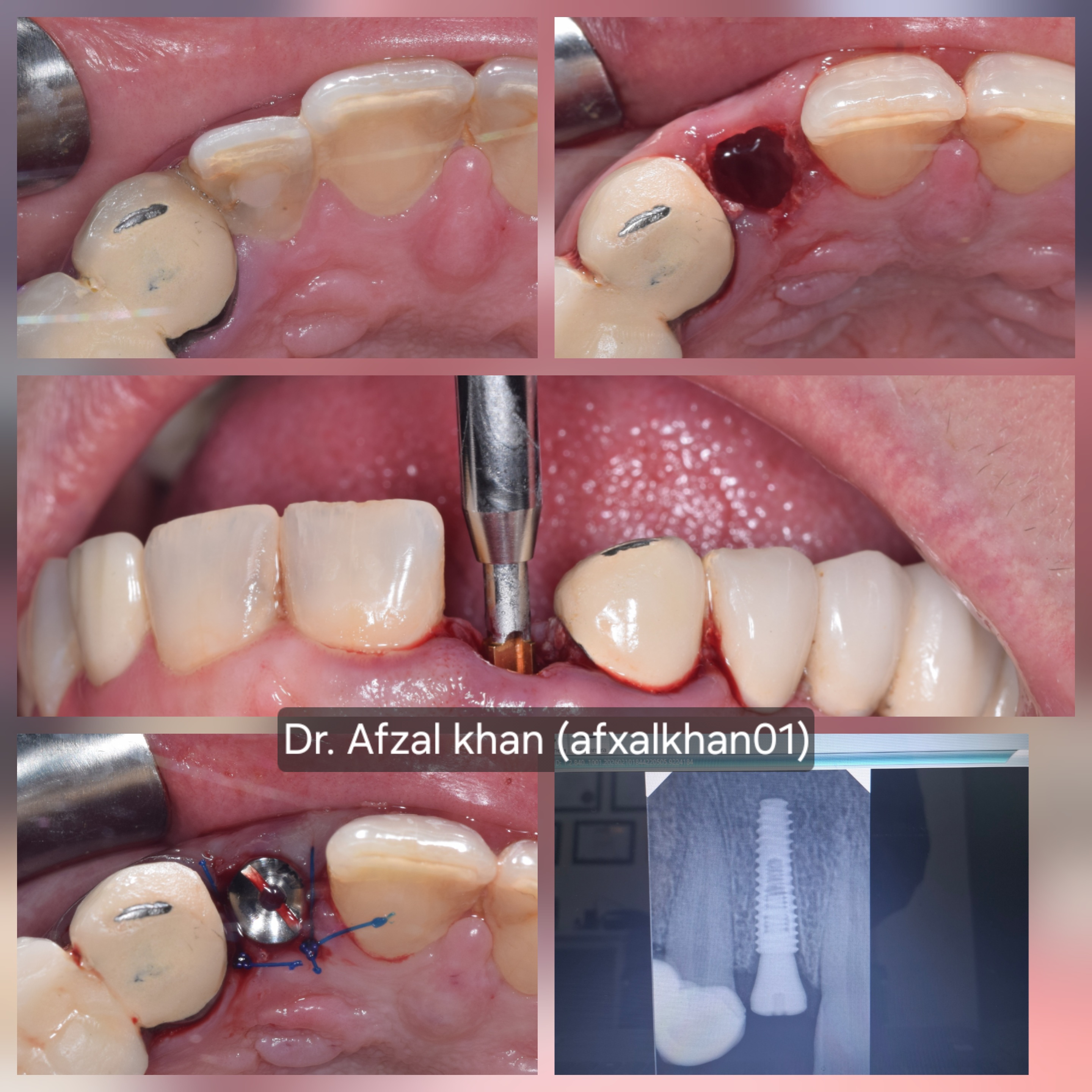 Dental Implant: Case 4, surgical photos and X-ray
