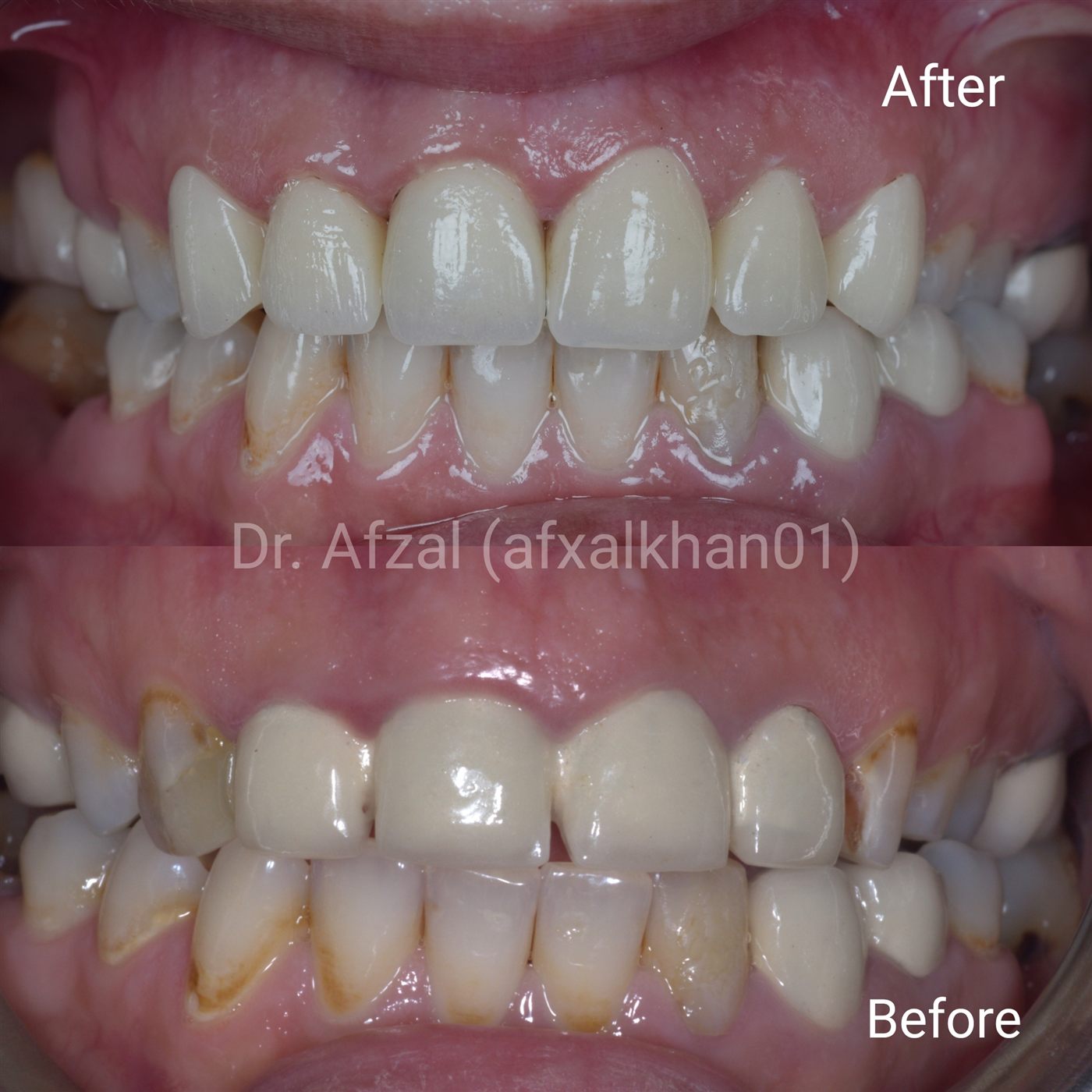 Smile Makeover: Case 2, before and after