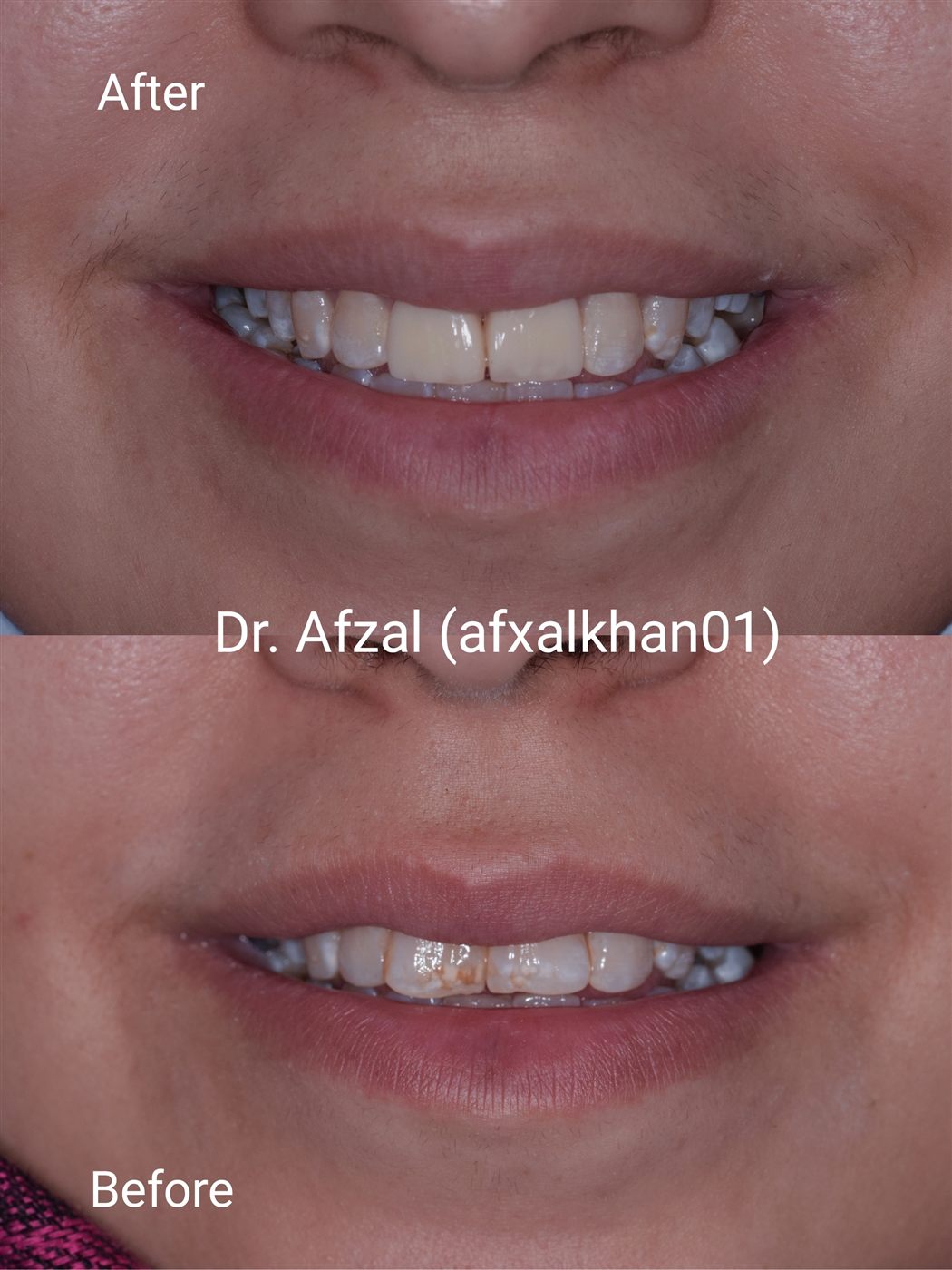 Smile Makeover: Case 3, before and after