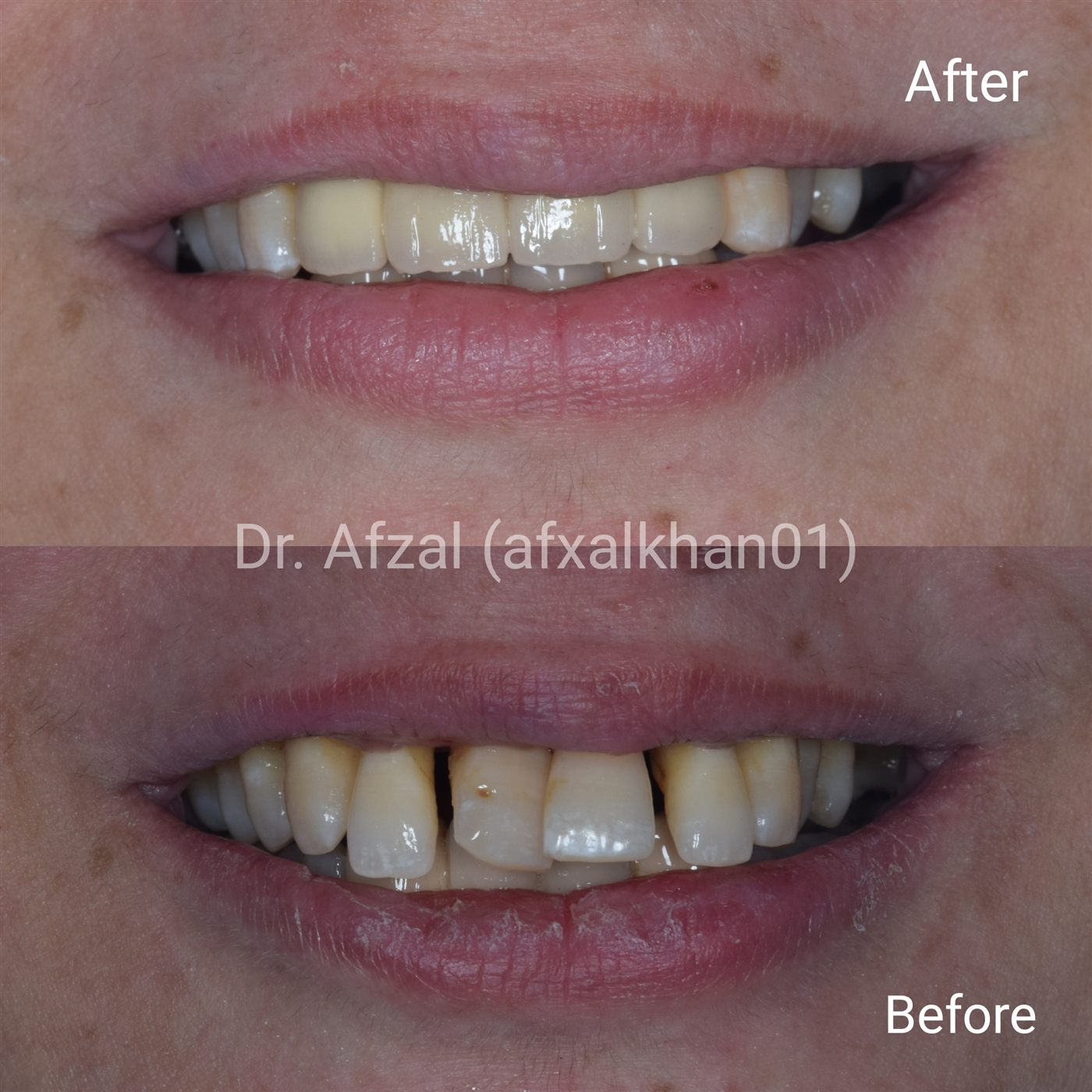 Smile Makeover: Case 4, before and after