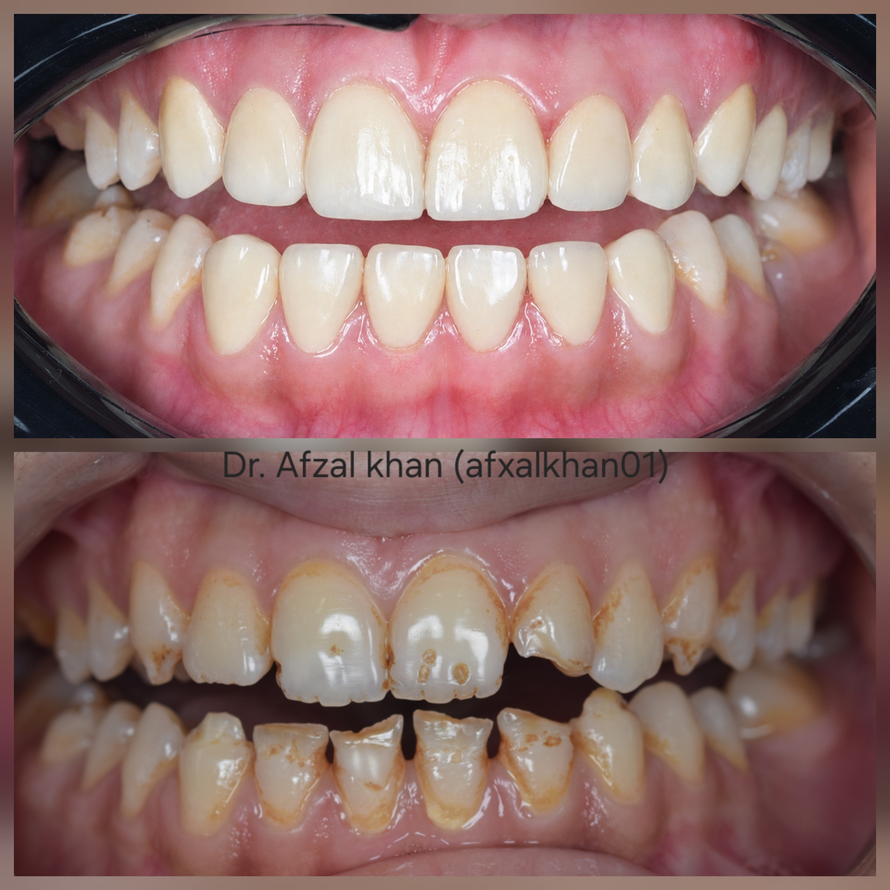 Smile Makeover: Case 5, before and after