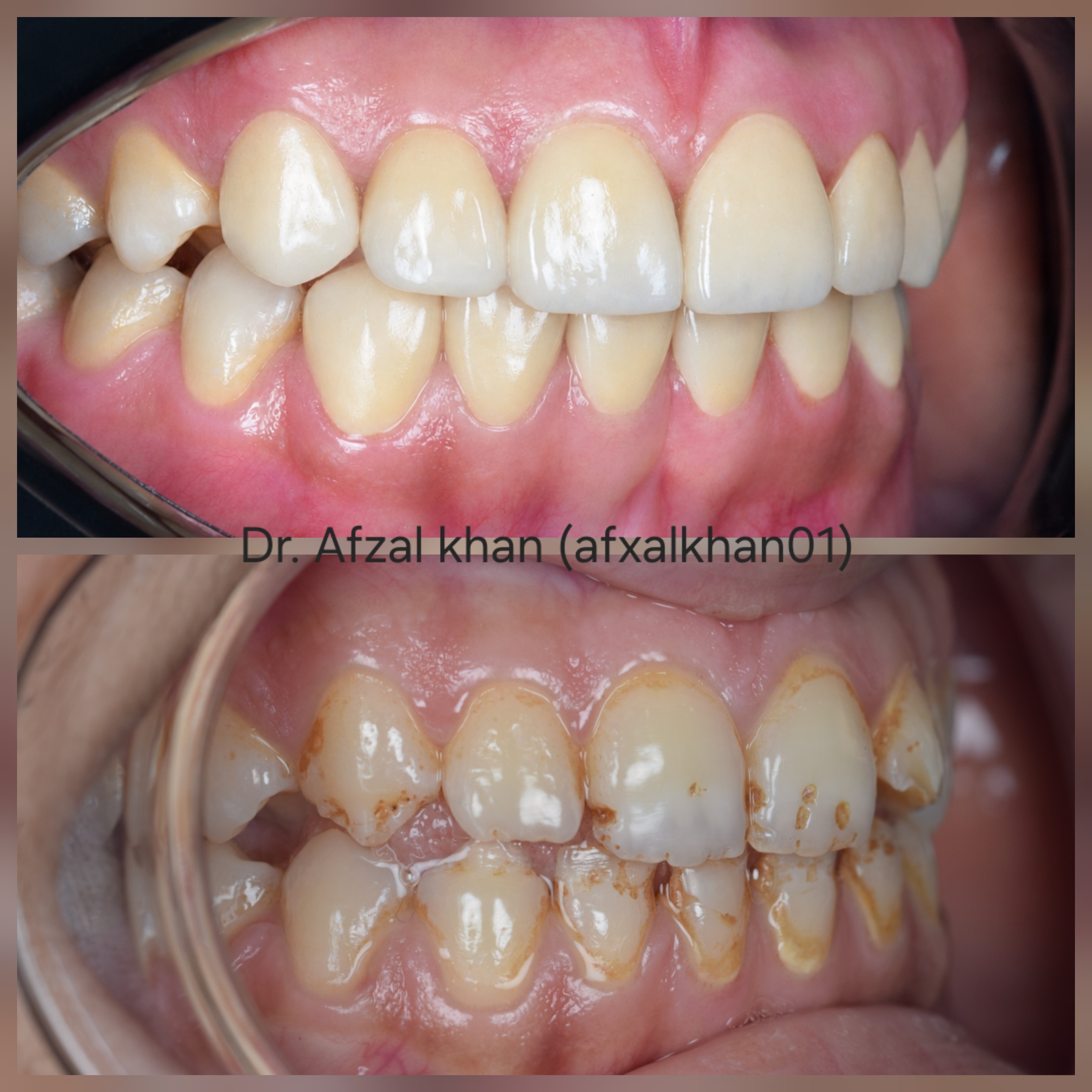 Smile Makeover: Case 6, before and after