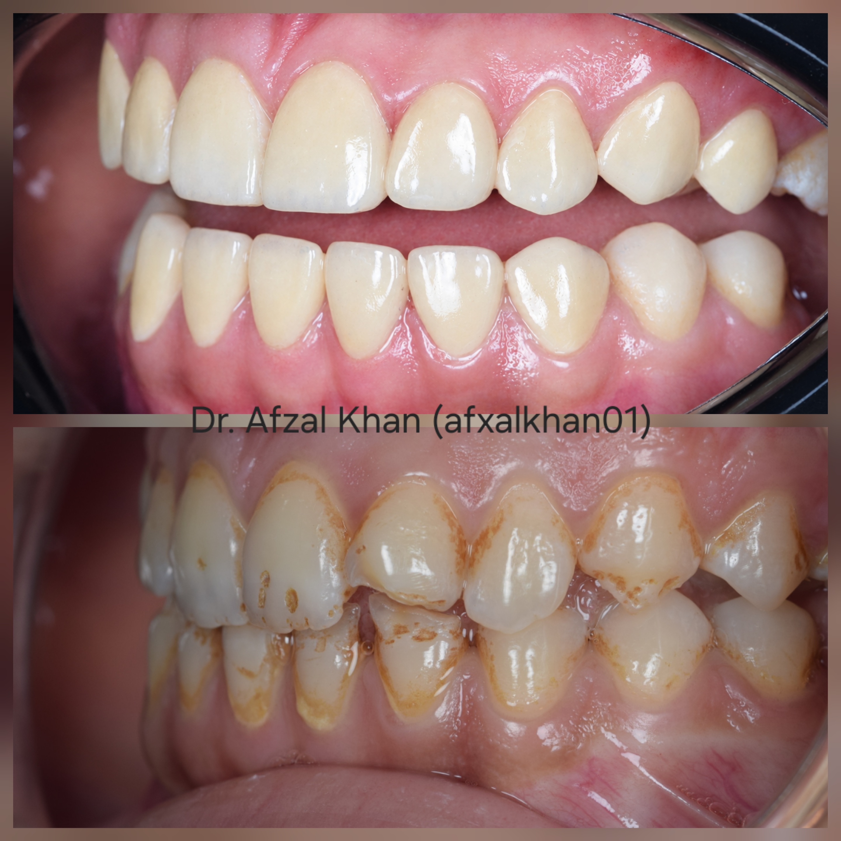 Smile Makeover: Case 7, before and after