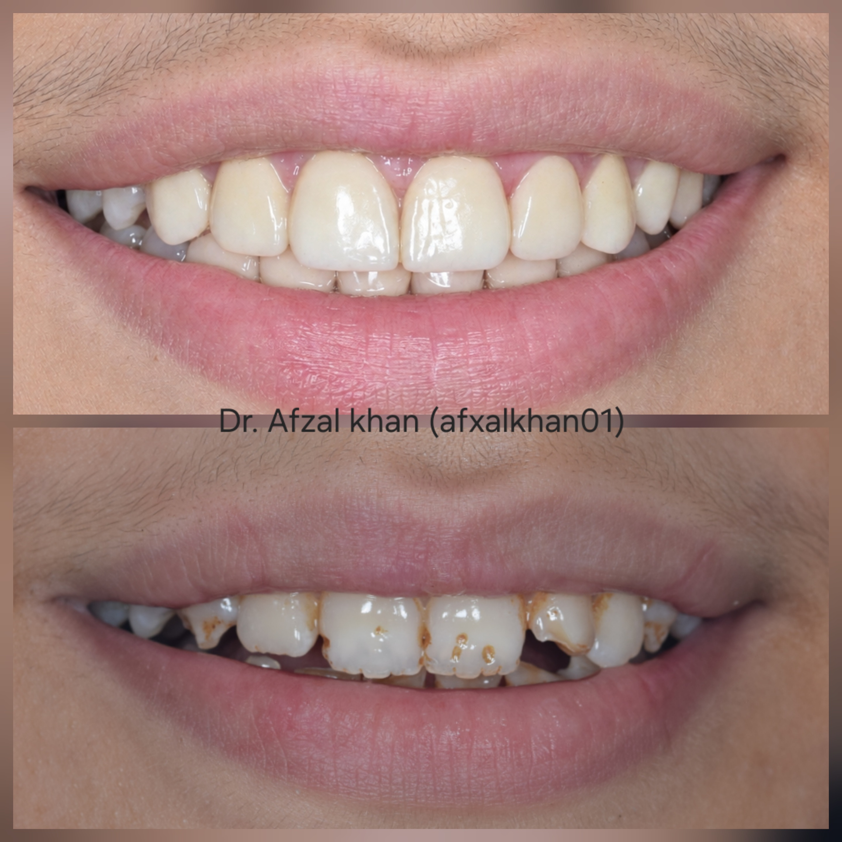 Smile Makeover: Case 8, before and after
