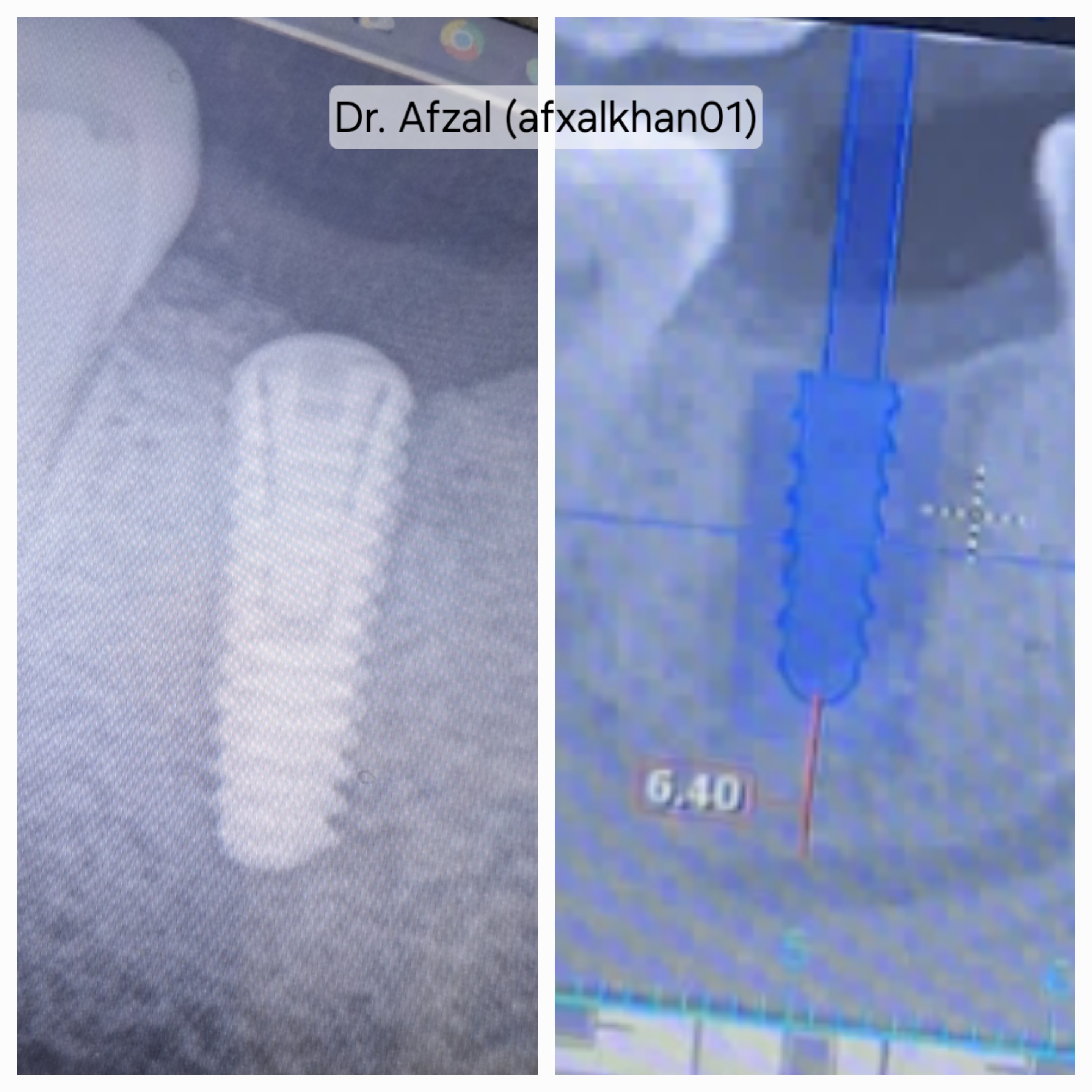 Dental Implant: Case 1, surgical photos and X-ray